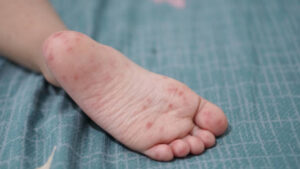 Virus Coxsackie: qué es y cómo afecta a los niños