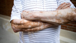 Científicos del IPN investigan vínculo de la obesidad como factor para tener vitíligo