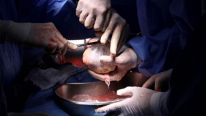 Los trasplantes de órganos cambian vidas: “Le das a alguien la oportunidad de seguir viviendo”