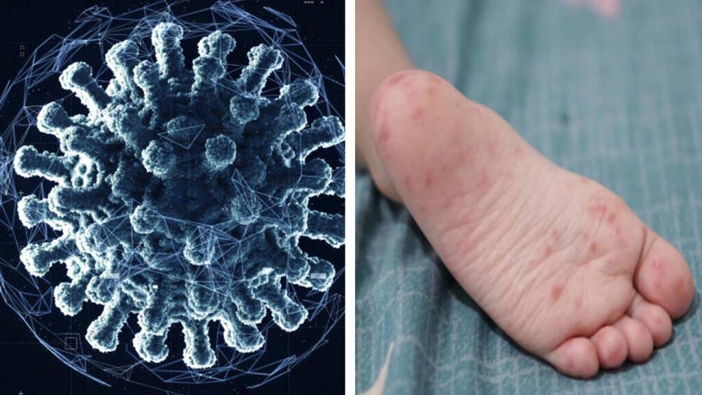 Virus Coxsackie se presenta principalmente en menores