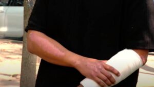 Juan Luis enfrenta secuelas físicas y emocionales a un mes de la explosión en el Puente de la Concordia